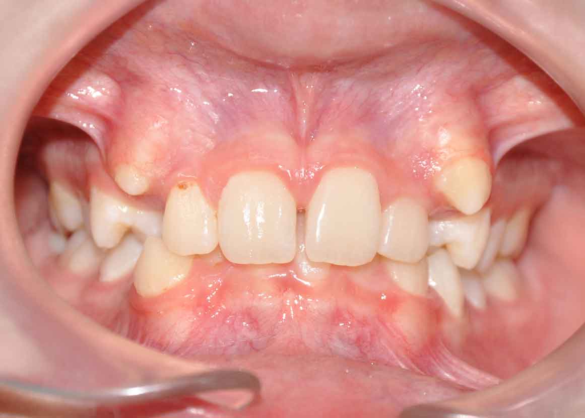 problems with crowded teeth