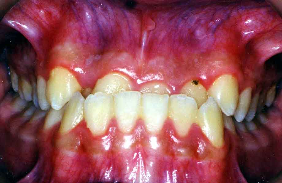 Anterior Crossbite