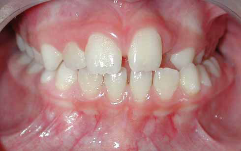 Posterior Crossbite